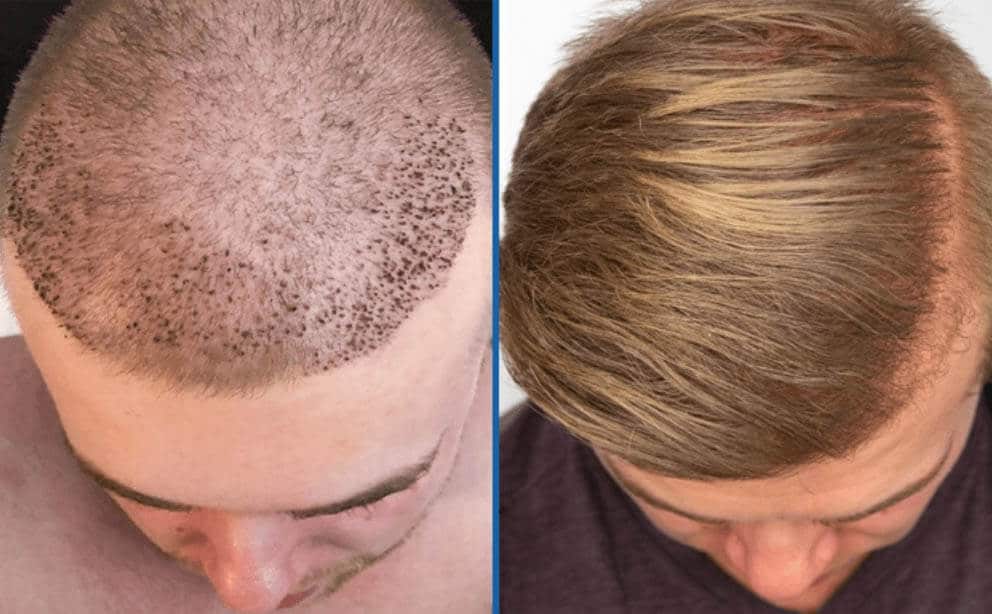 Best Hair Loss Treatment for Males in Dubai